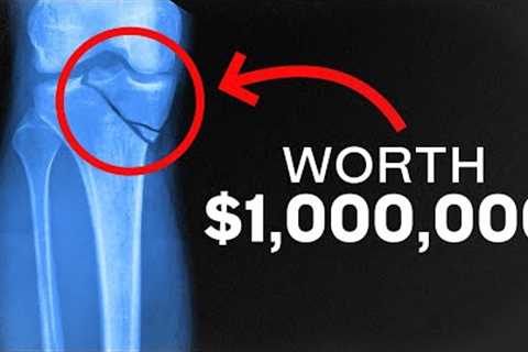 4 Surprising Injuries That Might Pay You $1,000,000
