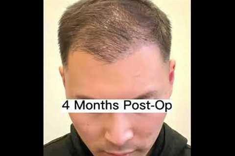 Hair Transplant Timeline 0-12 Months (Trust The Process)