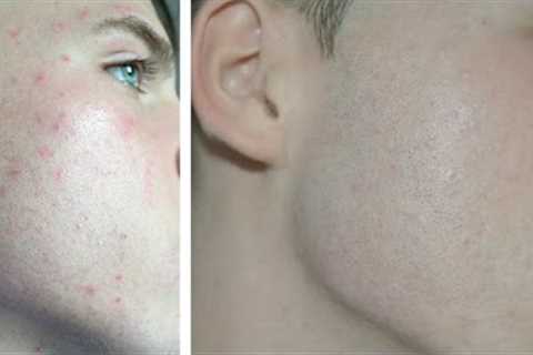 Invisible Makeup Tutorial For Guys - With Acne -