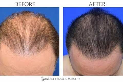 Platelet-Rich Plasma for Hair Loss | PRP Hair Restoration With Microneedling | Beverly Hills, CA