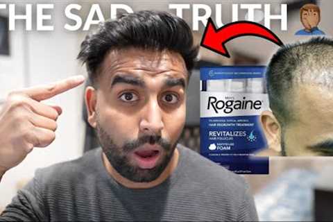 Does Rogaine Work? | My Biggest Regret 6 Years Later... 🤦‍♂️