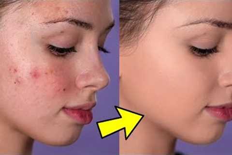 How To Cover Acne and Blemishes  ( EASY &amp; NON-CAKEY )
