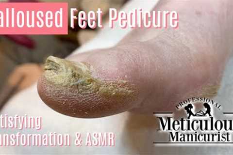 👣How to Pedicure Extremely Calloused Feet and Toes ASMR👣