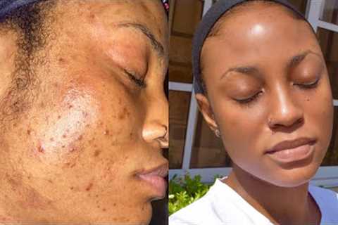 SKINCARE ROUTINE FOR OILY ACNE PRONE SENSITIVE SKIN || How I deal with Hyper Pigmentation &amp;..