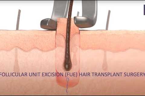 What is an FUE hair transplant?