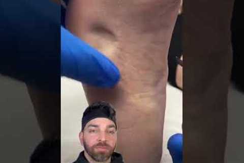 Painful BUMP on the Bottom of the Foot | Doctorly #shorts