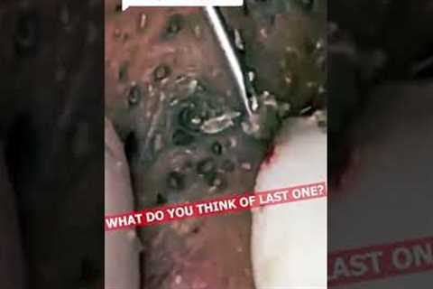 pimple popping 2022 new,  SUPER blackheads REMOVAL, pimple popping tiktok #7889
