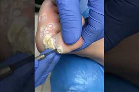 Professional pedicure: treating warts with care