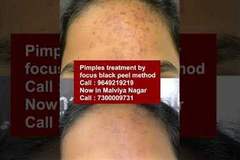 Best Pimples treatment by focus black peel method at skinaa clinic | Viral #shorts