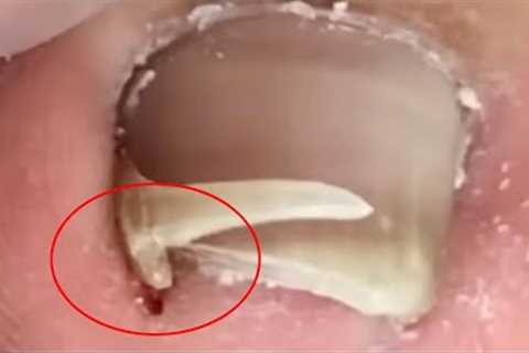 Amazing! The huge ingrown armor was dug out【Crazy pedicure room】