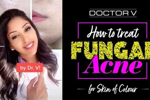 Doctor V - How To Treat Fungal Acne For Skin Of Colour | Brown Or Black Skin | #shorts