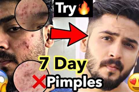 3 Tips For Pimple Free Clear Skin | Remove Pimple and acne, Pimple Mistakes #shorts #skincare