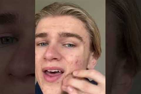 How to cover your acne as a guy