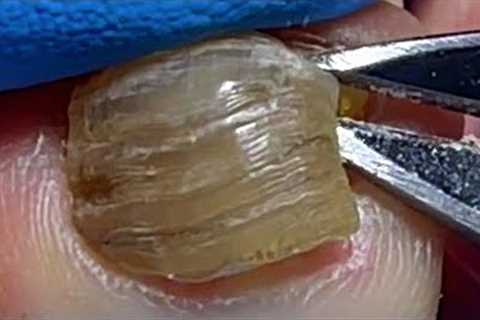 Pull out onychomycosis, the toenails have become completely empty【Pedicure Master Lin Jun】