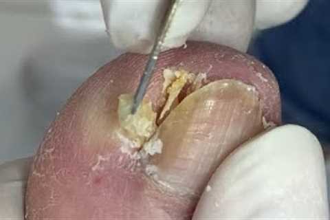 Huge depression after nail digging - Pedicure teaching