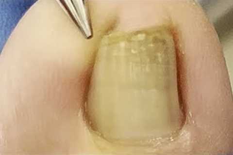 Amazing pedicure video! Extremely curly ingrown nails, digging out very large pieces of nails
