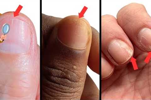 How to Survive Splitting Nails. Causes &amp; Remedies.