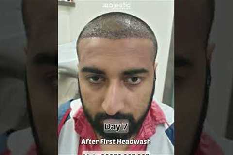 Hair Transplant Journey To Look Normal - Call 08376927927 #shorts #hairtransplant #hairloss #short