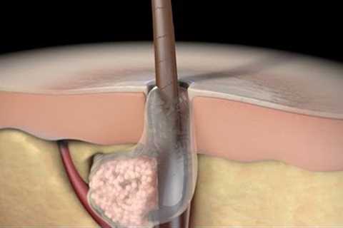 Acne: Understanding the Types of Acne and Treatment Options