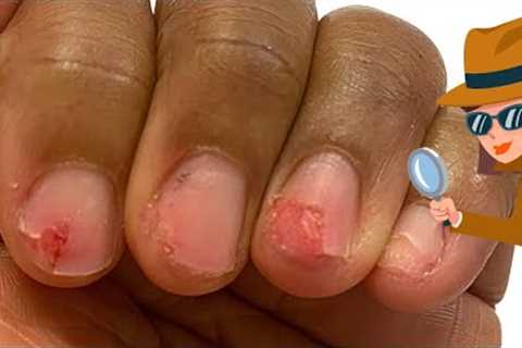 What can happen during acrylic removal and what's NEXT ➡️