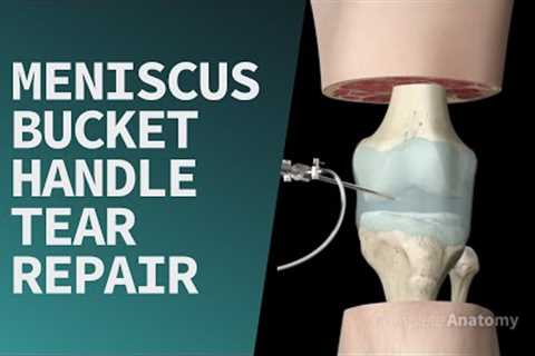 Meniscus Bucket Handle Tear Repair