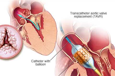 Update on Non-Invasive Procedures for Heart Valve