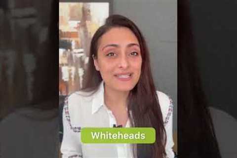 Whiteheads | treatment | affordable | dermatologist