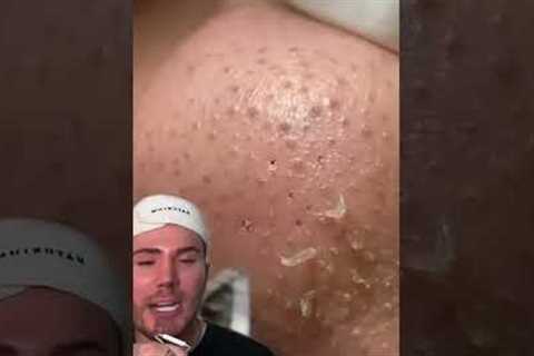 BLACKHEAD REMOVAL!😱 (follow for more💗) #acne #acnetreatment #skincare #skin #skincareroutine