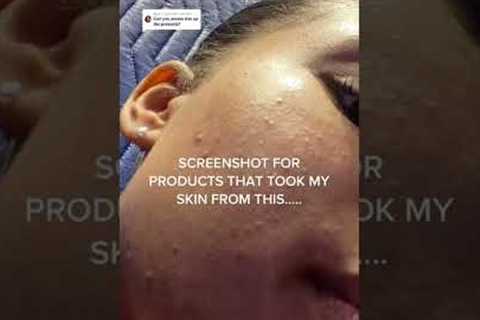 How I CLEARED My TEXTURED SKIN!! How I Got Rid Of Those Tiny Bumps On Skin!!
