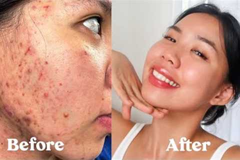 (ENG SUB) HOW I GOT RID OF MY ACNE, SCARS, TEXTURE &amp; HYPERPIGMENTATION  *not sponsored*