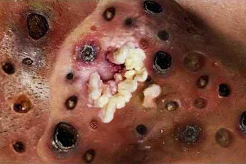 Big Cystic Acne Blackheads Extraction Blackheads &amp; Milia, Whiteheads Removal Pimple Popping..