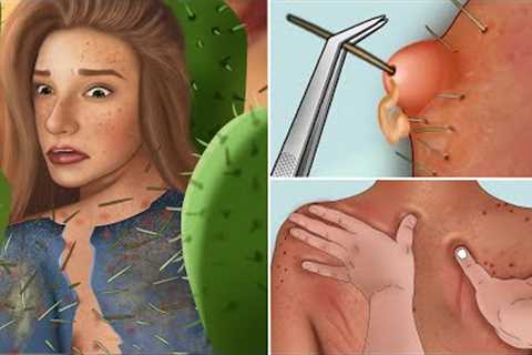 ASMR Treatment pustules caused by cactus thorns animation | Traditional Mexico massage