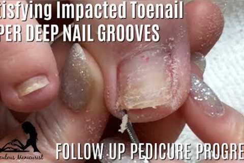 👣 Relaxing Impacted Toenail Pedicure Tutorial ASMR Massage 👣