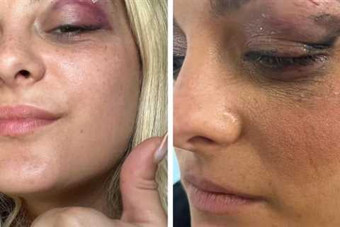 Bebe Rexha Shows Off Injuries After Being Hit with Cell Phone: 'I'm Good, Yeah, I'm Feelin' Alright'