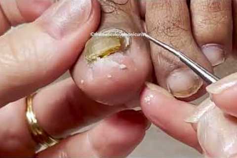 👣 Pedicure Toenail Cleanings (part 2) 👣