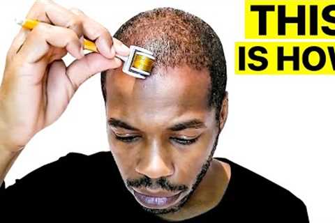 Derma Rolling for Hair Regrowth Results 3 Months | Surgeon Reacts