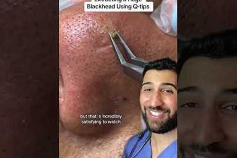 Extracting a Huge Blackhead Using Q-Tips #acne