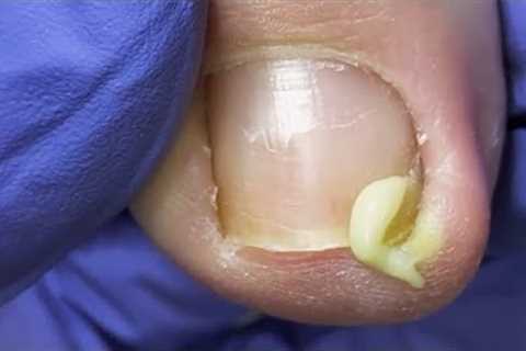 Ingrown Toenail Removal || Toenail Cutting || Toenails burst【Master Wang pedicure】