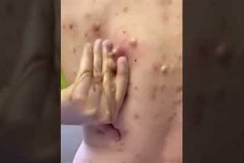 pimple popping 2022 new, blackheads on nose, pimple popping tiktok #4523rww
