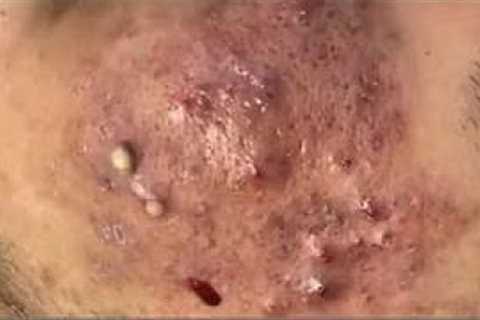 Blackheads &amp; Milia,😱 Big cystic acne blackheads, whiteheads Removal Pimple Popping New This..