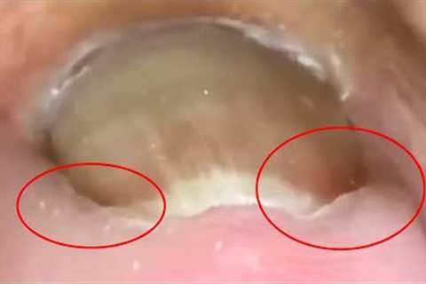 Crooked toenails with giant ingrown nails deep inside【Crazy pedicure room】