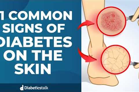 11 Common Signs of Diabetes on The Skin