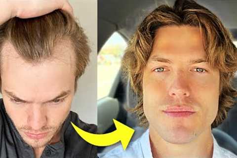 My Turkey Hair Transplant Results After 1 Year | Before &amp; After