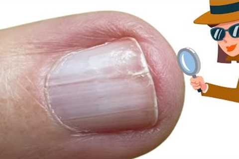 Splitting nail problems [Anna's Nail Advice]