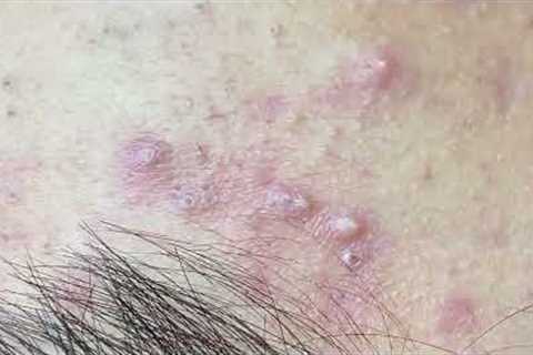 Cystic Blackheads Extraction New This Week #sacdepspa