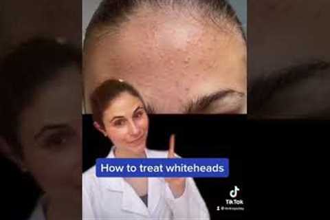 How to treat whiteheads #Shorts