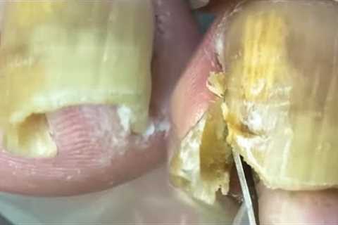 Amazing toenails! Never seen such ingrown armor【Crazy pedicure room】