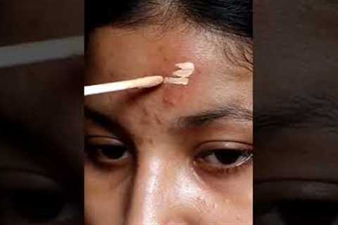 How to hide active  acne / acne marks using make-up .
