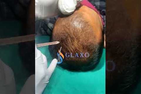 my first PRP session after hair transplant/ prp for hair loss treatment/prp therapy/#shorts