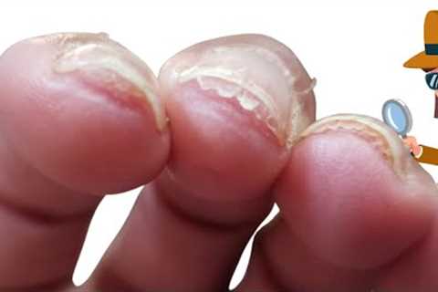 Why is the nail separating from nail bed? [Nail bed hyperkeratosis?]